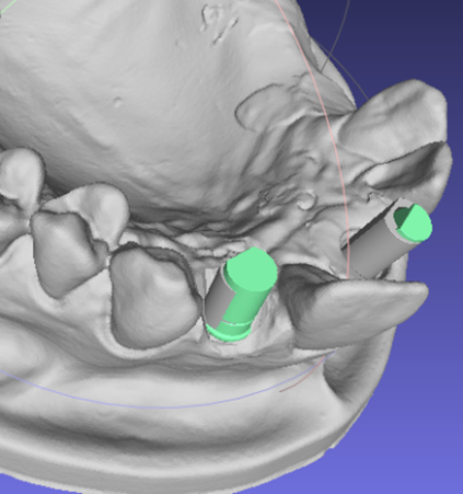 3D Jaw Scan Processing